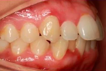 în timp ce purta aparat dentar și de îngrijire a sistemului de suport (de îngrijire) în timp ce purta aparat dentar și de îngrijire a sistemului de suport