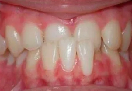 In timp ce poarta aparat dentar și de îngrijire a sistemului de suport (poartă aparat dentar) în timp ce purta aparat dentar și de îngrijire a sistemului de suport