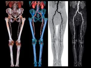 Boli ale inferioare simptomele extremităților și tratamentul bolilor vasculare ale picioarelor