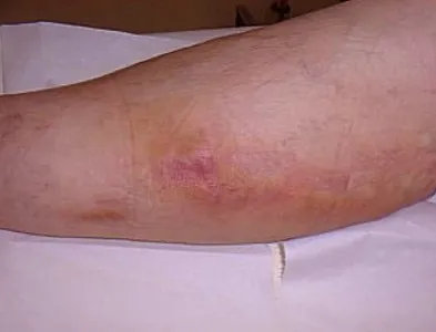 Boala vasculară a simptomelor inferioare ale picioarelor și extremități de tratament, ce să facă atunci când durerea