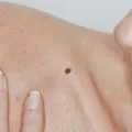 Din ce apar papiloame pe gât Din ce apar papiloame pe gât