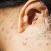 Herpes zoster tratament zona zoster Herpes zoster tratament zona zoster