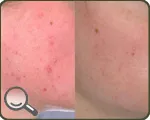Peeling comentarii ale pielii