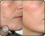 Peeling comentarii ale pielii