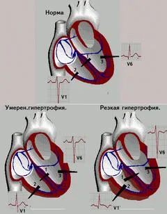 hipertrofiei ventriculului drept ce este