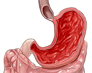 Gastro și tratamentul acesteia