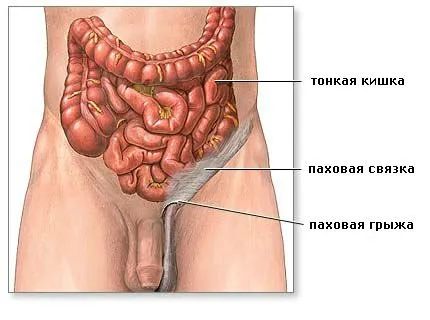 Ce este un testicul hernie