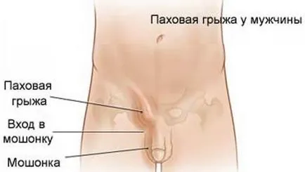 Ce este un testicul hernie