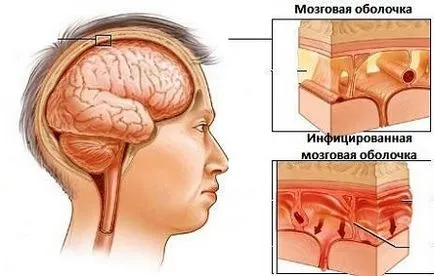 Ce este meningita purulentă