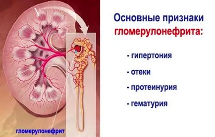 glomerulonefrita-l