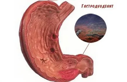 Gastro și tratamentul acesteia Gastro și tratamentul acesteia