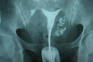 Adeziuni cum să-l trateze Adeziuni cum să-l trateze