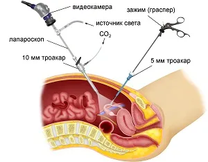 Adeziuni cum să-l trateze Adeziuni cum să-l trateze