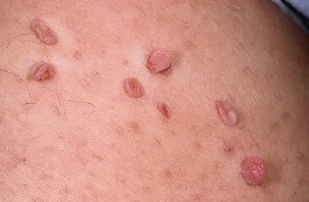 Cum obțineți HPV