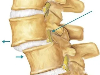 Cum de a reduce o vertebră Cum de a reduce o vertebră