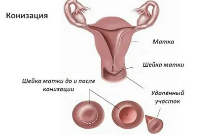 conization ce este conization ce este