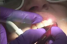 Ce este cu laser dinți de curățare