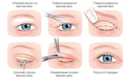 Pleoapele atârnă ca fiind