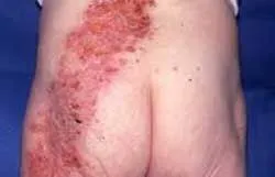 Herpes zoster tratament zona zoster
