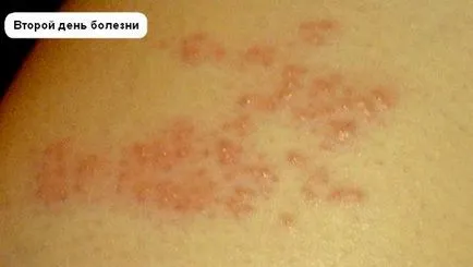 Herpes zoster tratament zona zoster Herpes zoster tratament zona zoster