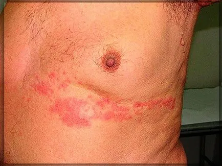 Herpes zoster tratament zona zoster