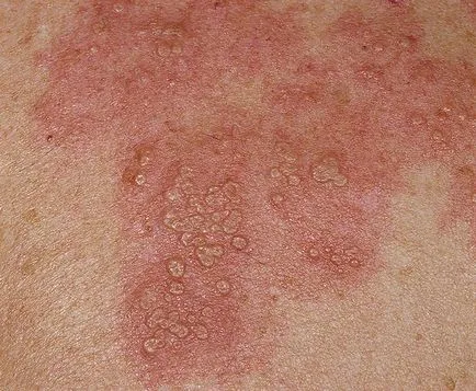 Herpes zoster tratament zona zoster Herpes zoster tratament zona zoster