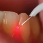 Ce este cu laser dinți de curățare Ce este cu laser dinți de curățare
