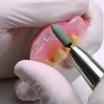 Ce este cu laser dinți de curățare Ce este cu laser dinți de curățare
