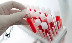 Cum de a crește celulele albe din sânge în urină Cum de a crește celulele albe din sânge în urină