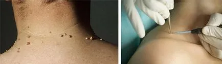 Din ce apar papiloame pe gât