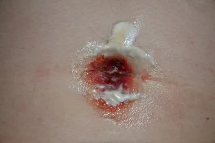 Cum de a vindeca un piercing buric Cum de a vindeca un piercing buric