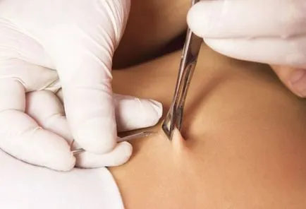Cum de a vindeca un piercing buric
