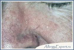 Ce este dermatita seboreica Ce este dermatita seboreica