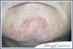 Ce este dermatita seboreica Ce este dermatita seboreica