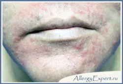 Ce este dermatita seboreica Ce este dermatita seboreica