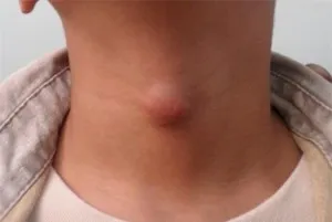 Ce este sub piele