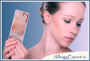 Ce este dermatita seboreica Ce este dermatita seboreica