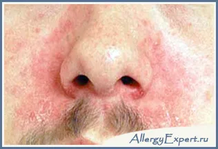 Ce este dermatita seboreica Ce este dermatita seboreica