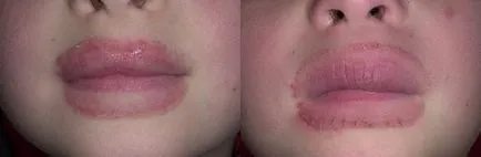 Ce este dermatita seboreica
