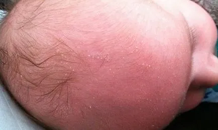 Ce este seboree la sugari