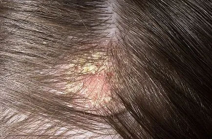 Ce este dermatita seboreica Ce este dermatita seboreica
