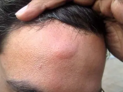 Cum de a elimina un cucui pe frunte
