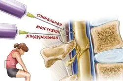 Ce este anestezie spinală