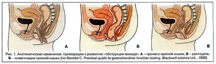 Rectala prolaps-l