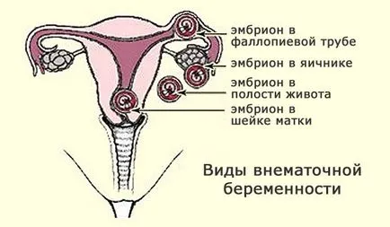 Cum și când apare o sarcina extrauterina