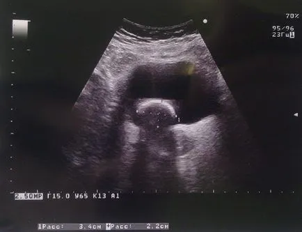 Ultrasunete a sistemului genito-urinar