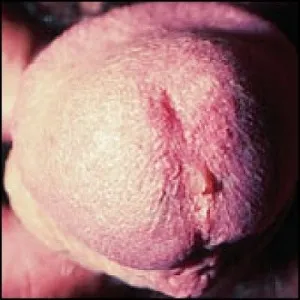 Cum se poate vindeca Chlamydia