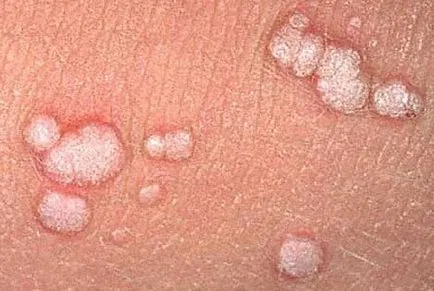 Cum obțineți HPV