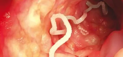 tratament anus Mâncărime tratament anus Mâncărime