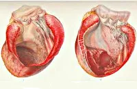 anevrism cardiac - cauze, simptome, diagnostic si tratament (anevrism) anevrism cardiac - cauze, simptome, diagnostic și tratament